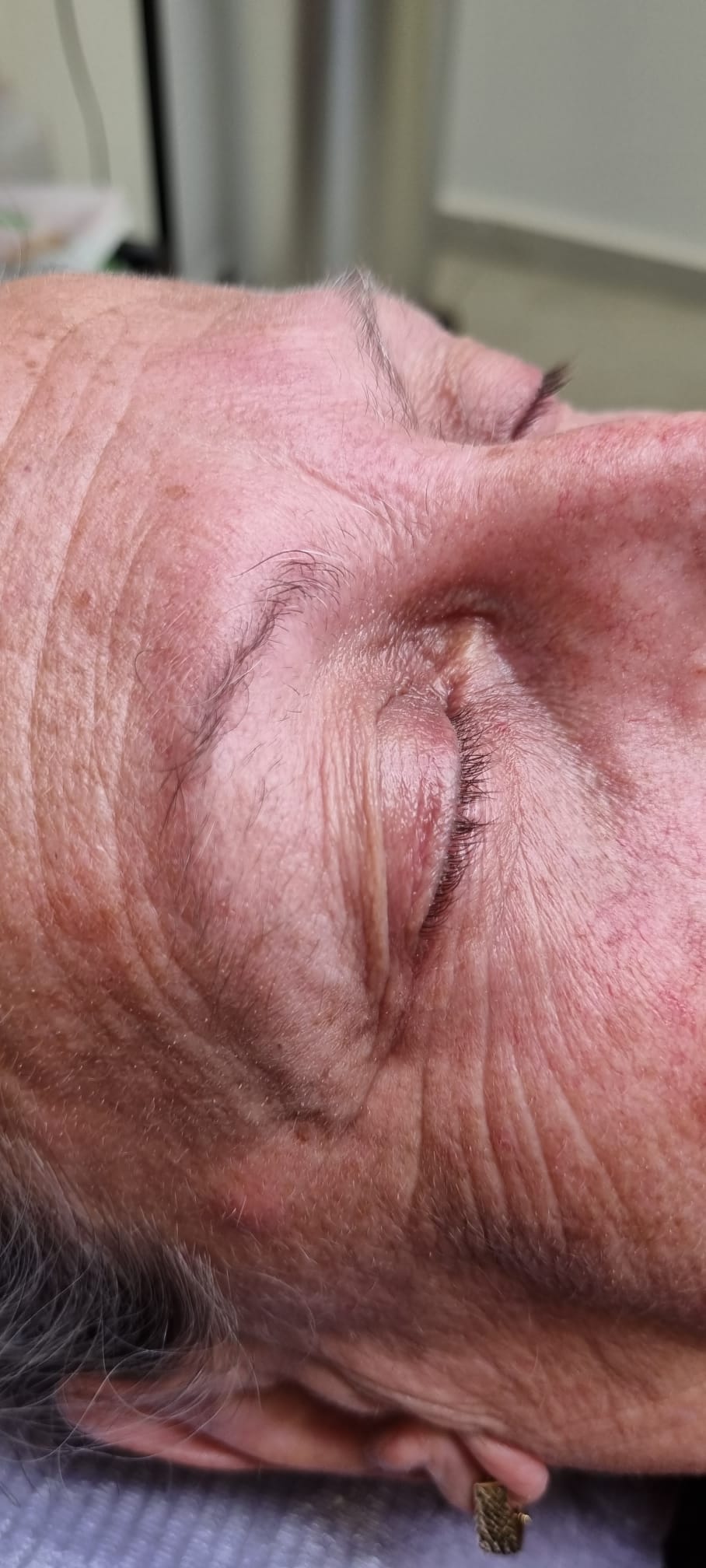 מיקרובליידינג 2